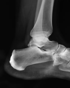 timalleolar fracture