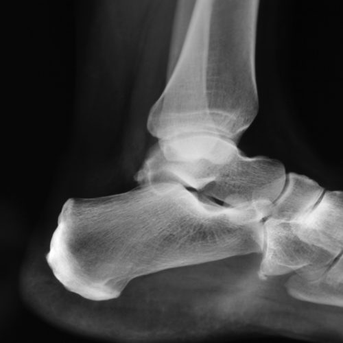 timalleolar fracture