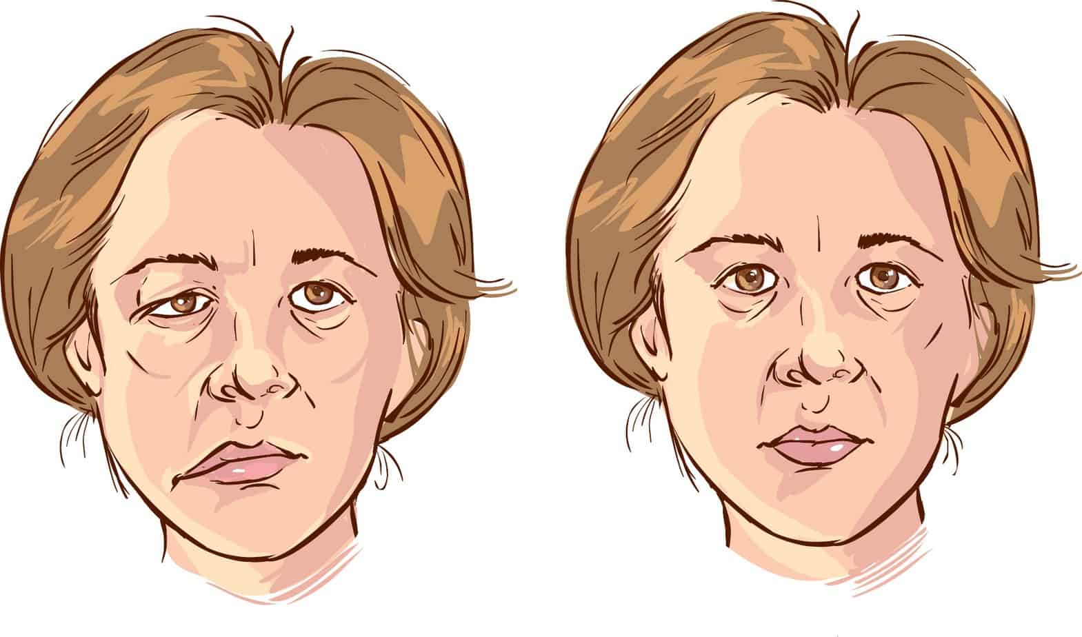 Bell's Palsy - Allied Medical Training